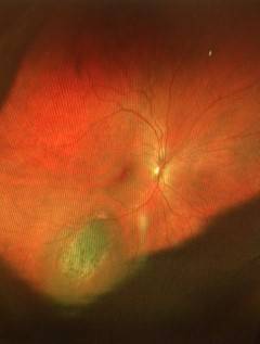 Choroidal melanoma - Freckle in the eye