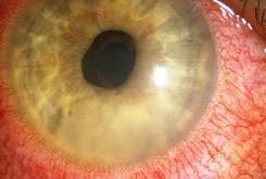 Close Up Image of Red Eye (Uveitis)