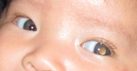 Image of eyes with abnormal white reflex retinoblastoma
