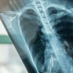 pulmonary fibrosis banner