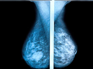 3D mammography breast scan X-ray image