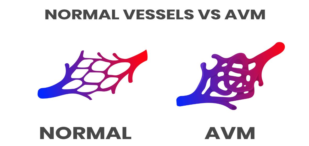 Normal vs AVM Vessels