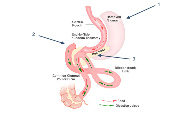 Single Anastomosis Duodeno-Ileal Bypass with Sleeve Gastrectomy