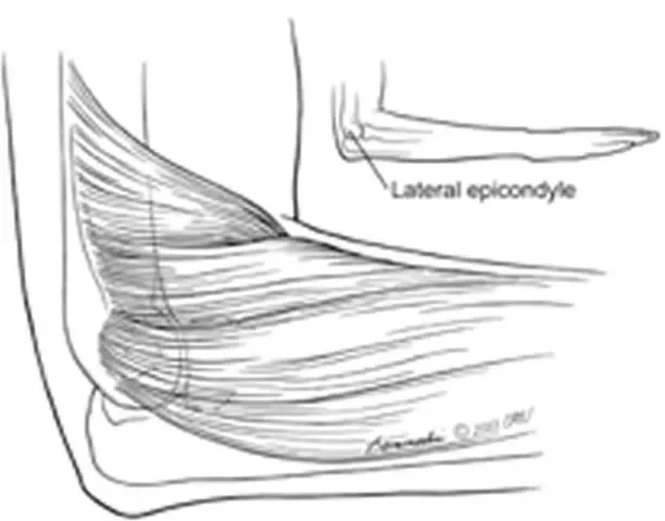 lateral-epicondylitis