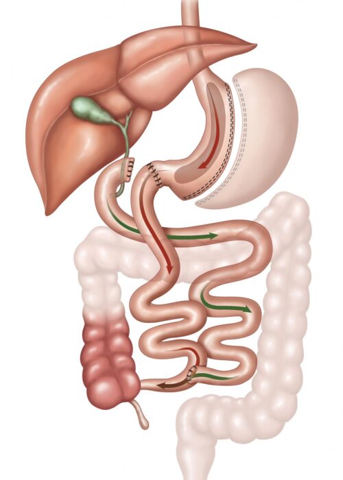 Biliopancreatic Diversion with Duodenal Switch