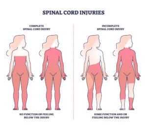 Complete and Incomplete Spinal Cord Injuries