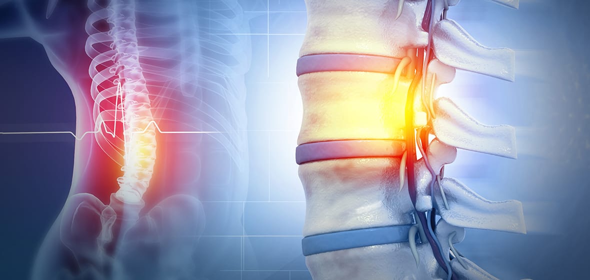 Complete and Incomplete Spinal Cord Injuries